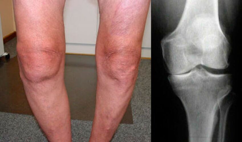 artrose van het kniegewricht