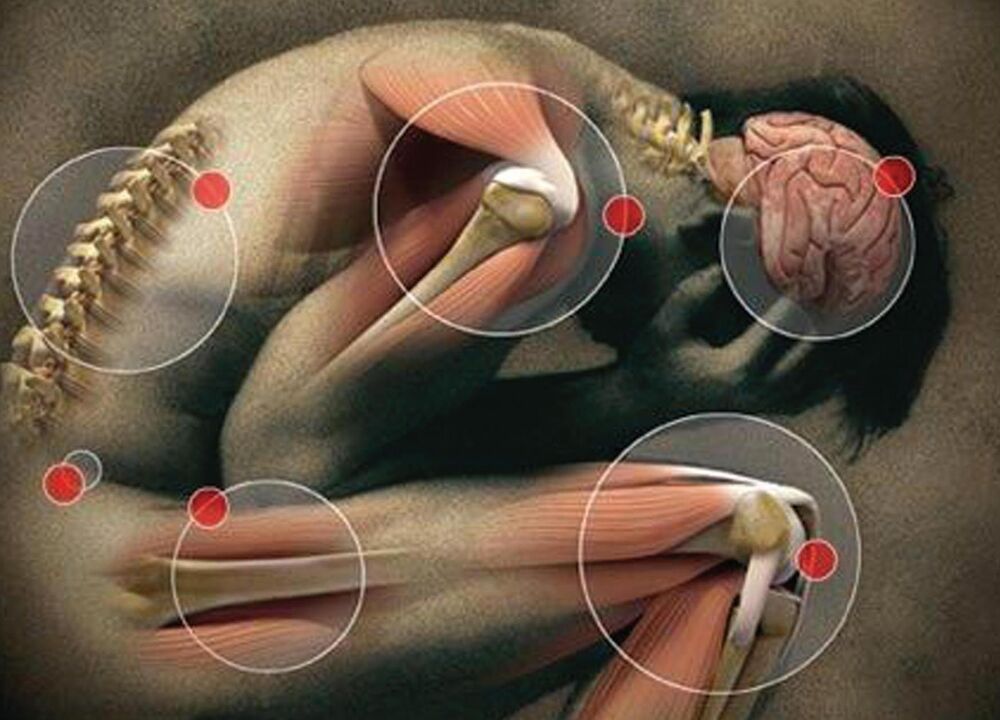 gewrichten van het lichaam aangetast door artrose