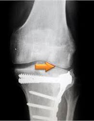 Arthrose van het kniegewricht